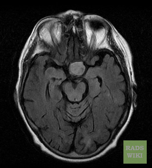 There is a well defined round lesion noted in the pituitary fossa, the lesion is slightly hyperintense on axial FLAIR.[2]