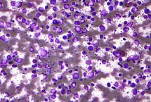 File:215px-Diffuse large B cell lymphoma - cytology low mag.jpg