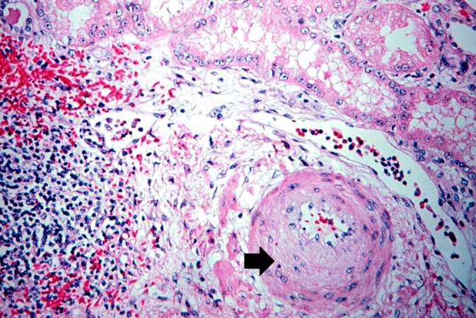 This is a photomicrograph of rejected kidney with a focus of cellular infiltrate (left) and a small artery with neointimal proliferation and stenosis (arrow).