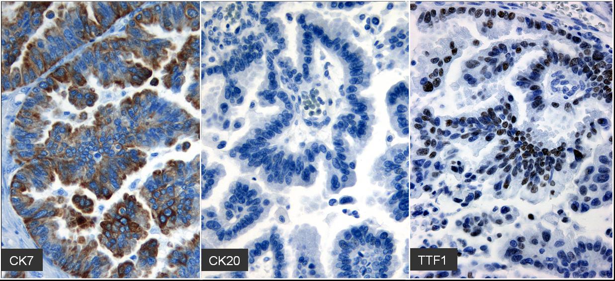 Immunohistochemistry profile of intracerebral metastases from an adenocarcinoma of lung (primary) demonstrating positivity to CK7, CK20, and TTF1.[11]