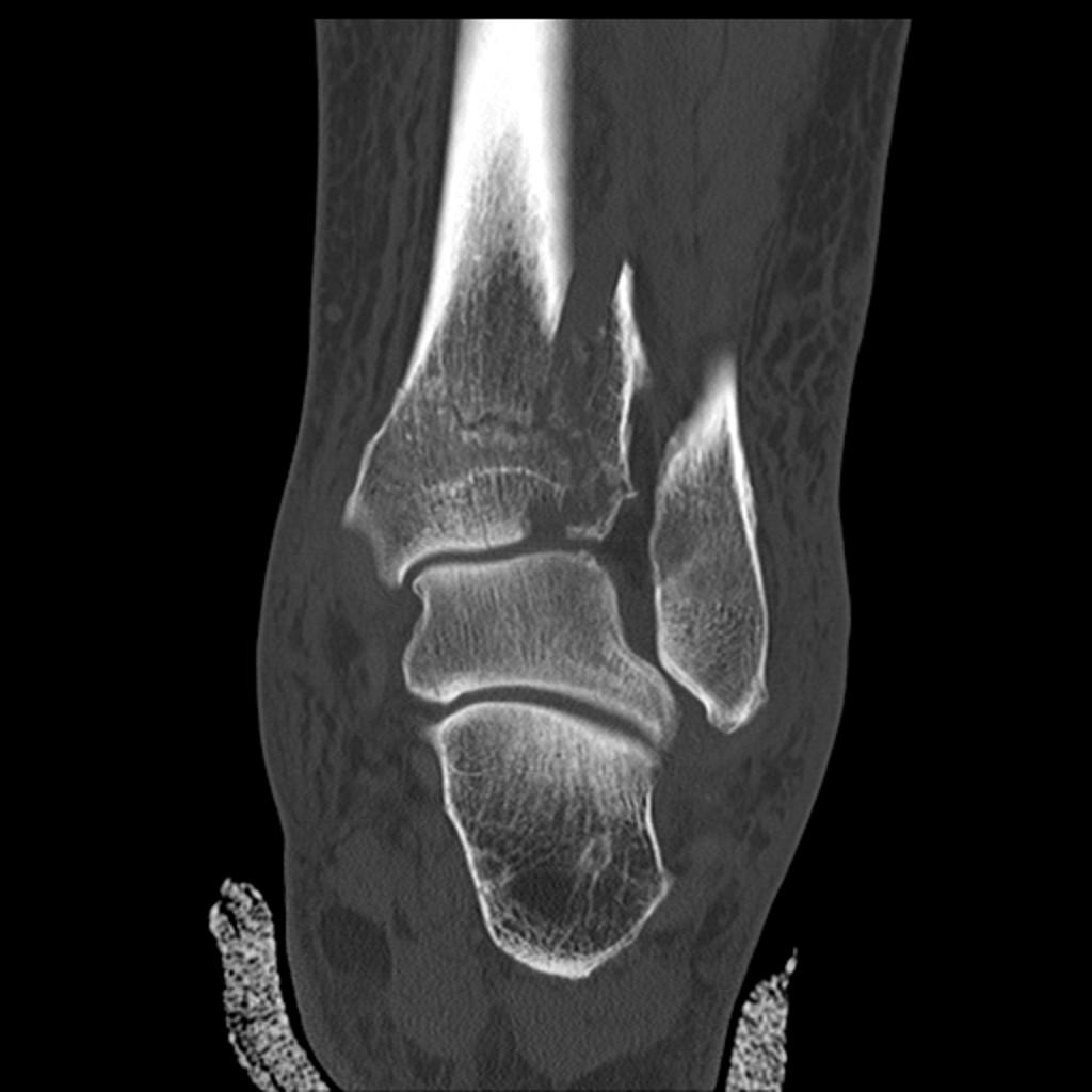 There is a comminuted distal tibial fracture extending into the tibial plafond, representing a Pilon fracture. There are also associated fractures of the talar dome and tip of the lateral malleolus.