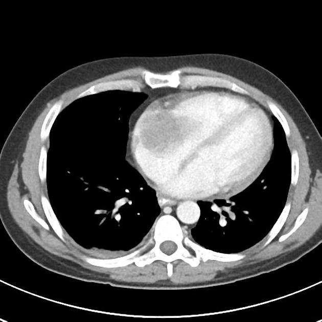 Image shows a 6cm x 4 cm mass in the right atrium consistent with tumor thrombus. A small pericardial effusion is noted.[7]