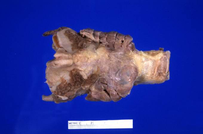 A gross photograph of thyroid gland taken at autopsy. The gland is only slightly enlarged and has a firm texture.