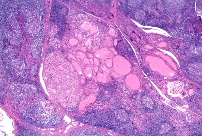This is a higher-power photomicrograph of thyroid from this case showing the inflammatory cells and the residual thyroid tissue.
