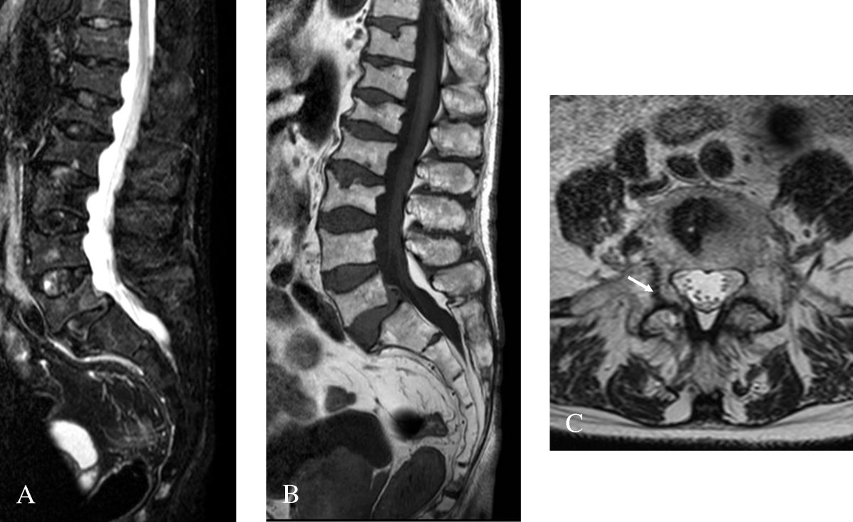 File:Morbus Fabry MRT Osteoporosis 01.jpg