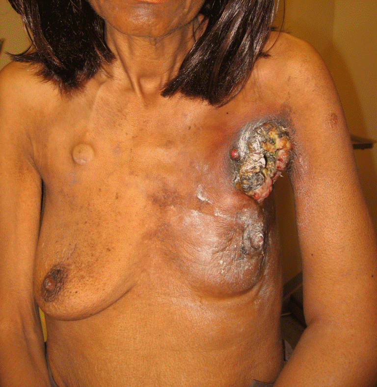 Patient with advanced local-regional recurrence of breast cancer with an ulcerating axillary mass