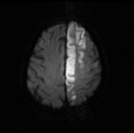 MRI- DWI