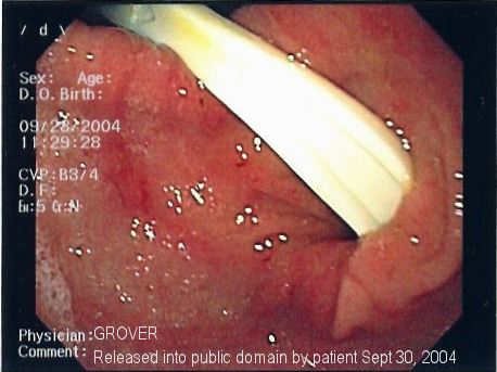 Gastric foreign body (toothbrush)