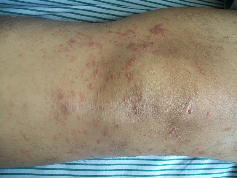 File:Mycosis fungoides.JPG