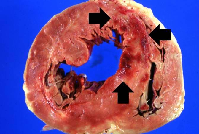 In this gross photograph of the heart from this case, note the area of fresh myocardial infarction (arrows) in the anterior portion of the left ventricle and extending into the anterior portion of the interventricular septum. Note that the walls of the left and right ventricle are slightly thicker than normal.
