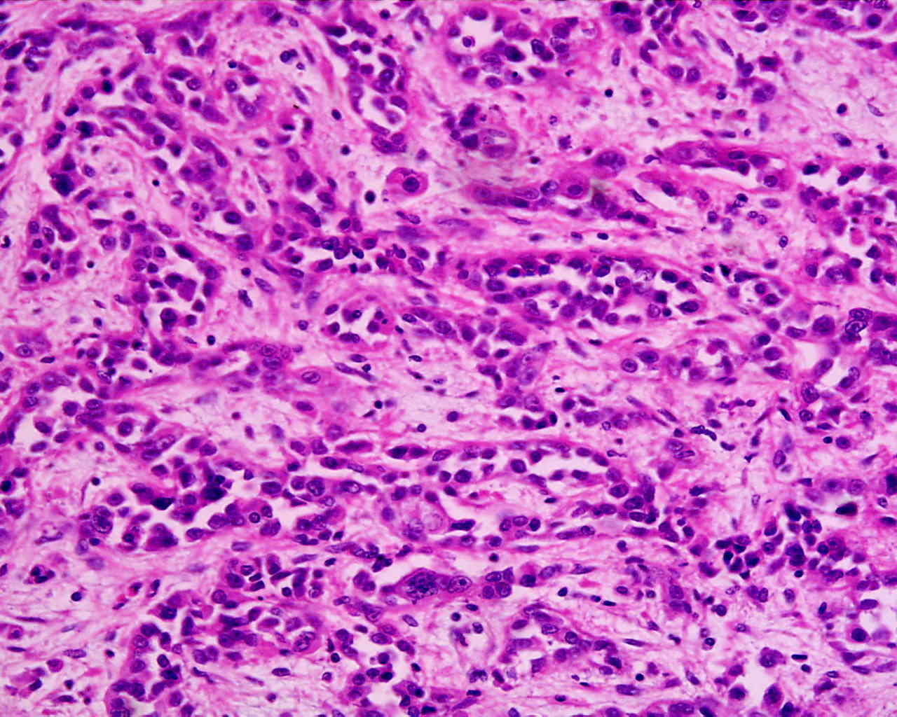 File:Adenocarcinoma low differentiated (stomach) H&E magn 400x.jpg