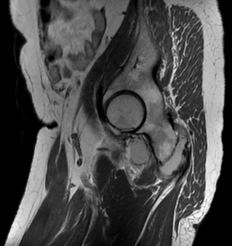 File:Hamstring tendon avulsion MRI 005.jpg