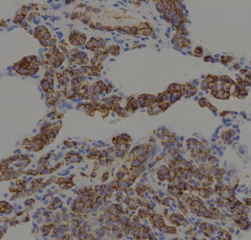 File:Intravascular large B-cell lymphoma pathology image 7 .jpg