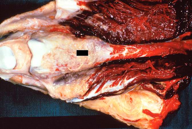 This is a gross photograph of the surgical specimen with tissue dissected away to demonstrate the tissue mass.