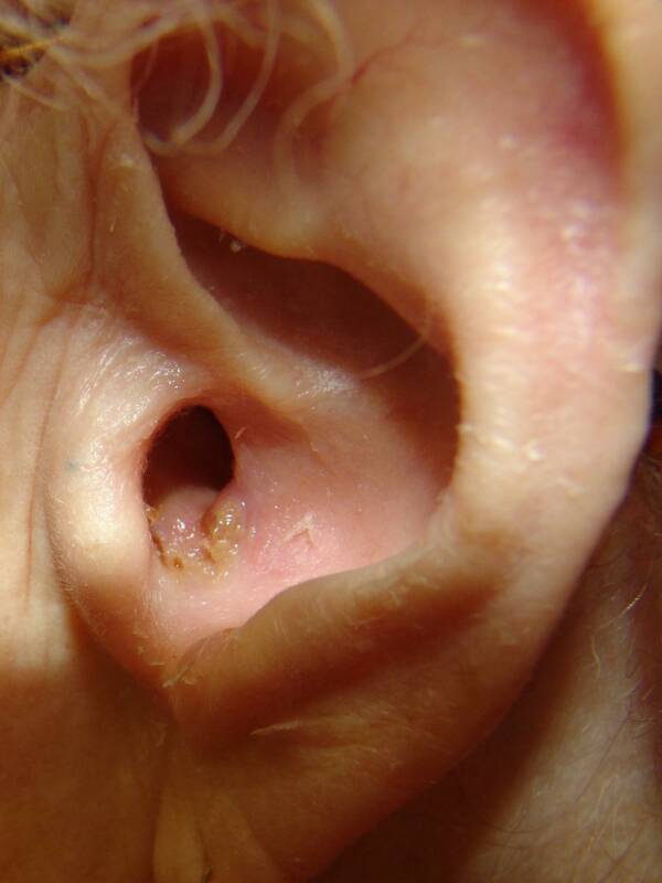 Boil (furuncle) occluding the right external auditory meatus[1].