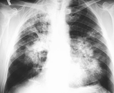 File:Pulmonary Tuberculosis X-ray3.jpg