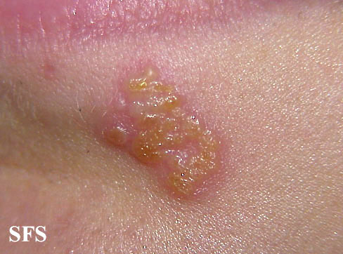 File:Herpes simplex 19.jpeg