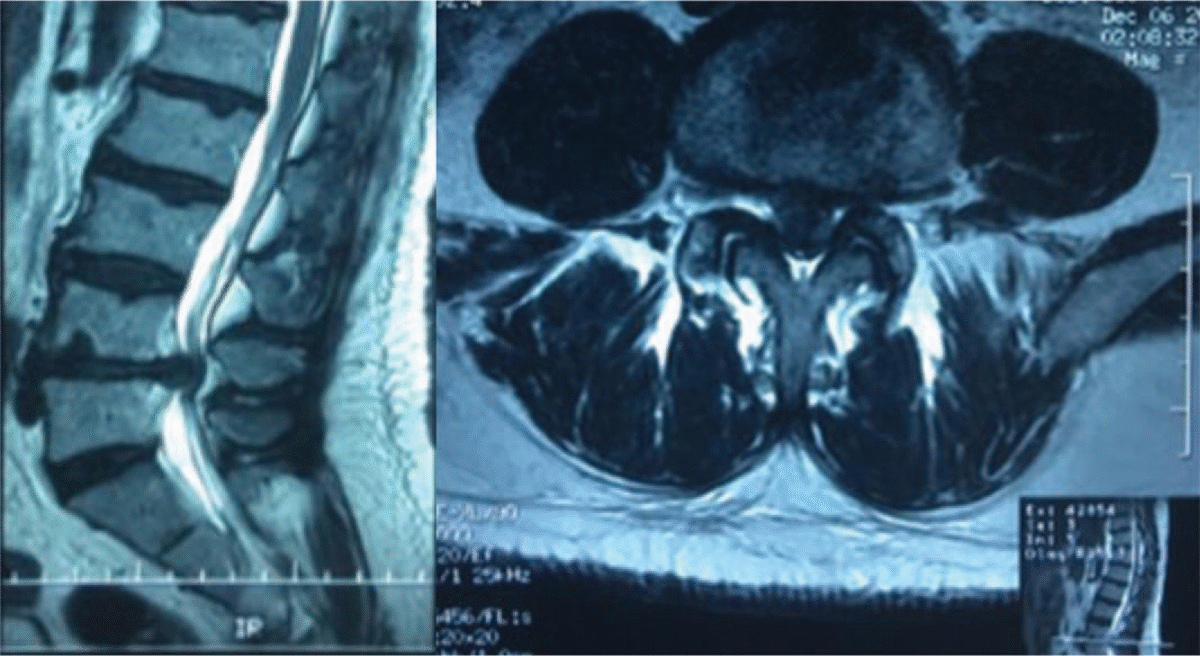 File:MRI Herniated disc.gif
