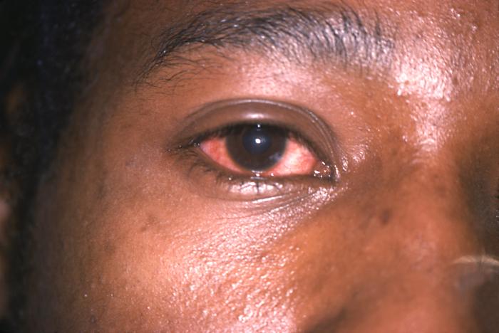 This patient with diagnosed gonococcal urethritis presented with unilateral gonococcal conjunctivitis. See PHIL 16400, for the appearance of her eye 24 hours following treatment with 4.8 million units of aqueous procaine penicillin G (APPG) and probenicid.If untreated N. gonorrhoeae bacteria may spread to the bloodstream, and thereby, throughout the body. The most common symptoms are then rash and joint pains, but other generalized symptoms may result as well such as conjunctivitis.Adapted from CDC