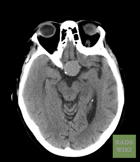 There is a well defined round isodense lesion noted in the pituitary fossa, the lesion is widening the [3]