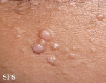 Nevoid basal cell carcinoma syndrome. With permission from Dermatology Atlas.[4]