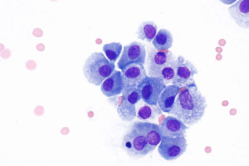 File:800px-Macrophages in bronchial wash specimen -- very high mag.jpg