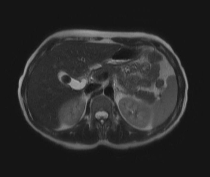 File:Cholelithiasis MRI 001.jpg