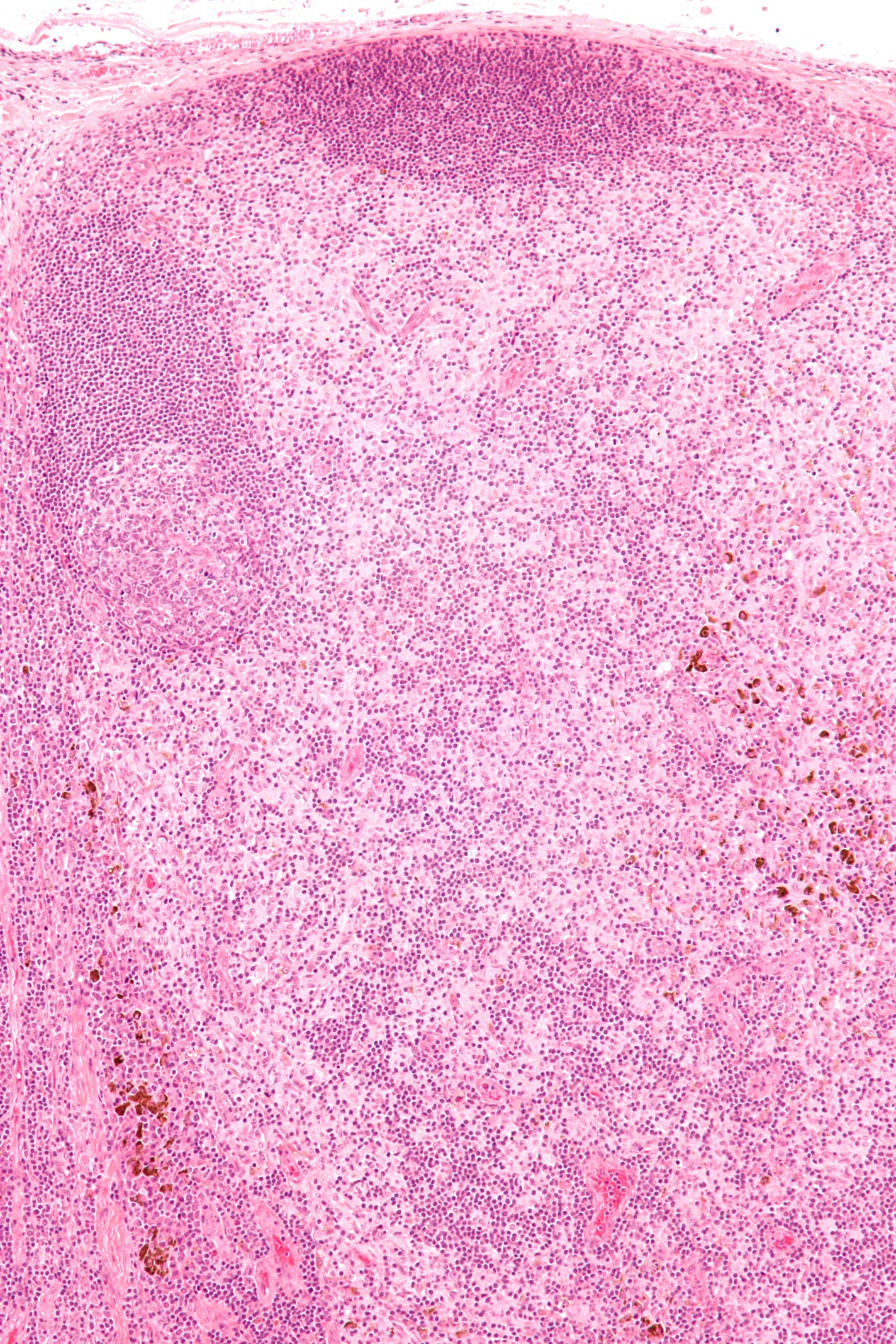 Micrograph of dermatopathic lymphadenopathy, a type of lymphadenopathy. H&E stain
