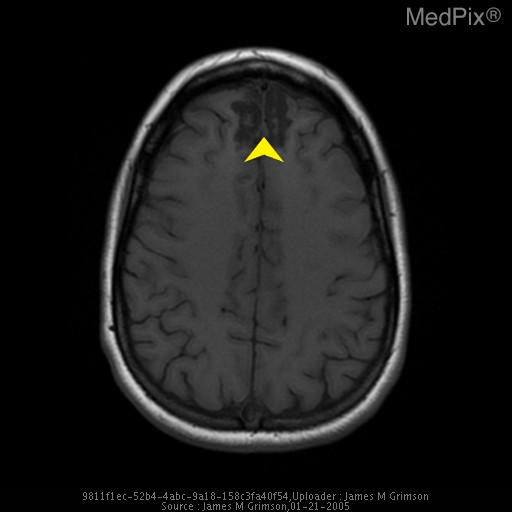 File:Axial MRI TBI.jpg