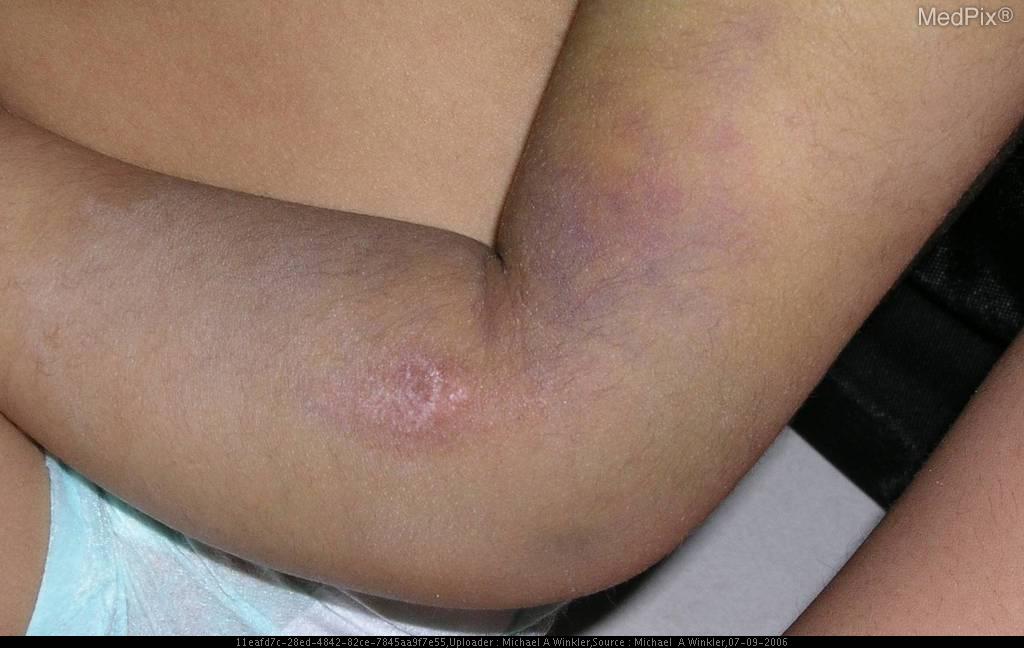 File:Bruises 3 Non accidental trauma.jpg