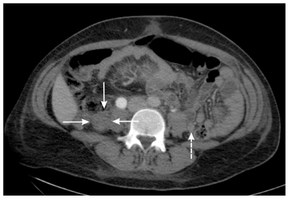 Normal left ovarian vein (dashed arrow) and right, enlarged and thrombi-filled, ovarian vein (three solid arrows)[2]