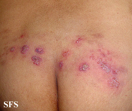 File:Herpes simplex 29.jpeg