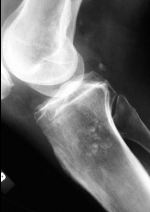 Low grade chondrosarcoma. Differential diagnosis is bone infarct (on plain film) and enchondroma