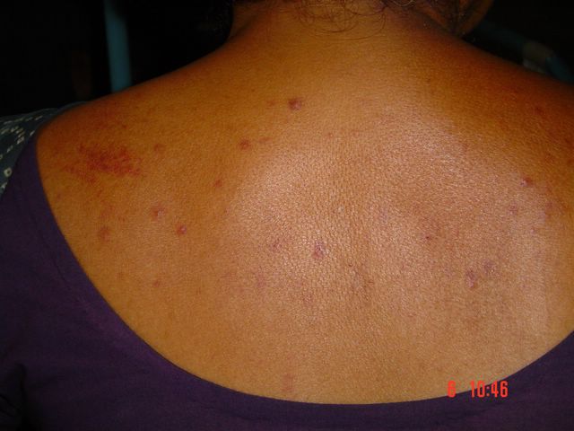 Petechial spots over the back