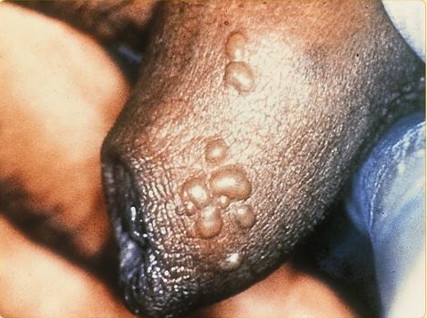 Genital herpes in a male