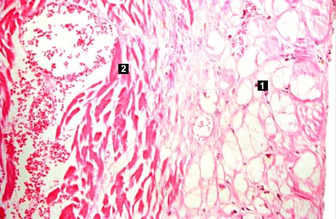 This high-power photomicrograph demonstrates the border between the vacuolated subendocardial myocytes (1) and the infarcted myocytes (2).