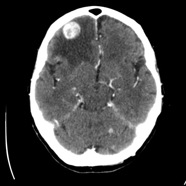Contrast CT scan of a 80 year old hispanic female with known history of lung cancer, presenting with impaired consciousness, demonstrates an enhanced mass in the right frontal hemisphere.[9]