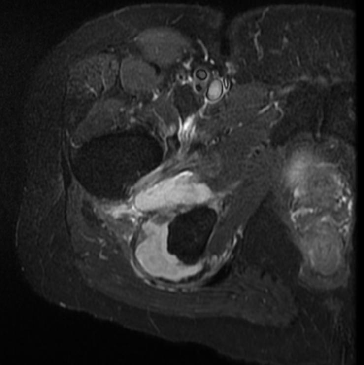 File:Hamstring tendon avulsion MRI 006.jpg