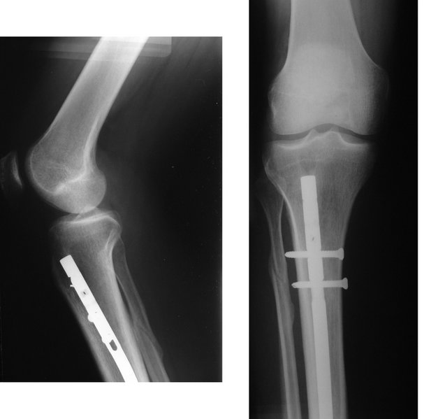 X-ray showing a healed tibia fracture with pins.