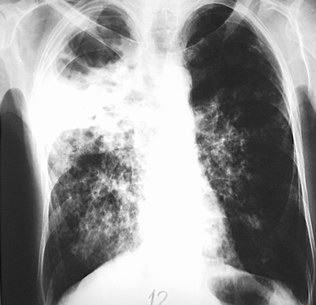 File:Pulmonary Tuberculosis X-ray.jpg