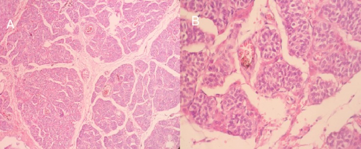 testicular parenchyma of lobulated architecture, made of seminiferous tubes of atrophic appearance; these tubes are lined with Sertolia cells, with no obvious signs of spermatogenesis the interstitium is fibrous with rare clusters of Leydig cells.[2]