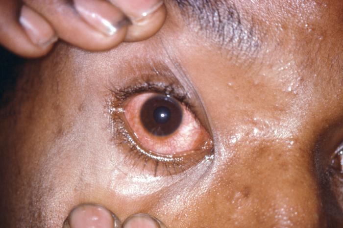 This patient presented with gonococcal urethritis, which became systemically disseminated leading to gonococcal conjunctivitis of the right eye. From Public Health Image Library (PHIL). [11]