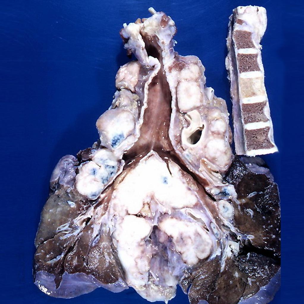 File:Hodgkin's lymphoma Gross Pathology.jpg