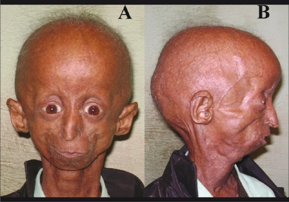 File:Hutchinson-Gilford progeria.jpg