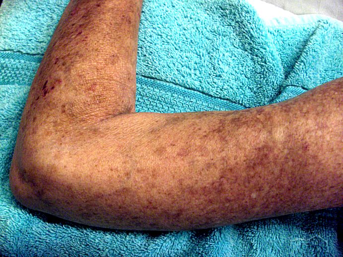 Left arm of Scleroderma patient, showing skin lesions Source:Images courtesy of Professor Peter Anderson DVM PhD and published with permission © PEIR, University of Alabama at Birmingham, Department of Pathology [12]