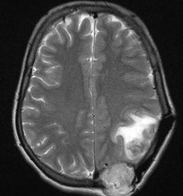 A 40 year old female previously operated for metastatic brain lesion from Ca thyroid presents with altered sensorium. Patient earlier had thyroidectomy 1 year ago. Axial T2 MRI scan reveals left parietal lobe lesion with adjacent perilesional edema with an skull vault lesion at the previous craniotomy site. Skull vault lesion shows intense homogeneous enhancement.[7]