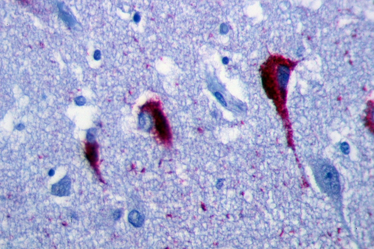 File:NF tangles in the Hippocampus Alzheimer tau protein.JPG