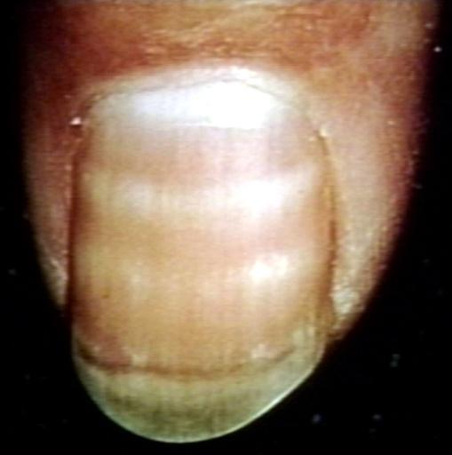 Nail disease; white banding