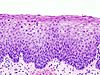 100px-Cervical intraepithelial neoplasia (3) CIN2.jpg