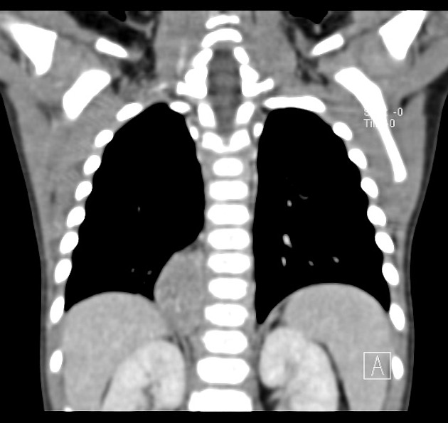 Neuroblastoma observed as a large right enhancing mass with central hypo-attenuation on coronal thoracic CT scan[3]